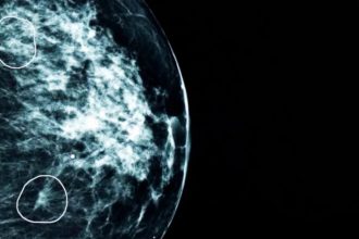 Cancer detection through NHS AI surpasses human capabilities, identifying tiny cancers missed by doctors